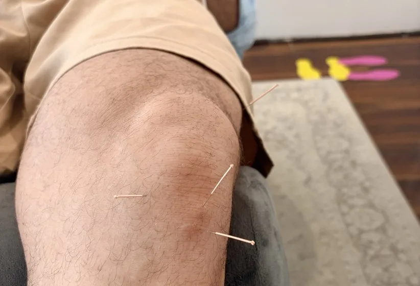 Dry needling needles placed in a patient’s leg